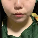 二重埋没 / 脂肪吸引（顔） ルラ美容クリニック 名古屋本院 DAY 4 サムネイル用