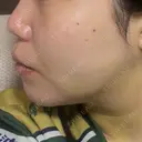 二重埋没 / 脂肪吸引（顔） ルラ美容クリニック 名古屋本院 DAY 4 サムネイル用