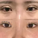 二重埋没 / 脂肪吸引（顔） ルラ美容クリニック 名古屋本院 DAY 4 サムネイル用