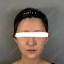 脂肪注入（額） / ボトックス（あご） / ヒアルロン酸注入（唇） / 脂肪注入（輪郭） アリエル美容クリニック 大宮院 DAY 32 サムネイル用