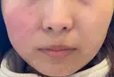 その他（輪郭） / 医療痩身（顔） / その他（肌） / RF（高周波）たるみ治療 / オンダリフト ライブリークリニック 船橋院 AFTER サムネイル用