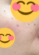ピコスポット APスキンクリニック銀座 DAY 5 サムネイル用