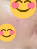 ピコスポット APスキンクリニック銀座 DAY 6 サムネイル用