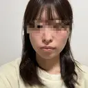 糸リフト / 脂肪吸引（顔） RIVER CLINIC（リバークリニック） DAY 4 サムネイル用