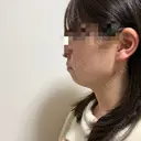 糸リフト / 脂肪吸引（顔） RIVER CLINIC（リバークリニック） DAY 7 サムネイル用