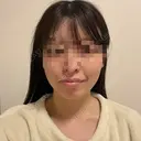 糸リフト / 脂肪吸引（顔） RIVER CLINIC（リバークリニック） DAY 9 サムネイル用