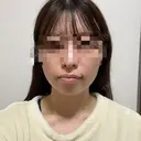 糸リフト / 脂肪吸引（顔） RIVER CLINIC（リバークリニック） DAY 13 サムネイル用