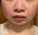 ほくろ・いぼ除去レーザー（肌） / ピコスポット Fellez Clinic【フェルズクリニック】 DAY 7 サムネイル用
