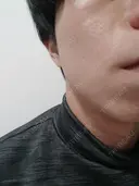ボトックス（エラ・小顔） 白金ビークリニック 本院 DAY 39 サムネイル用