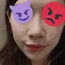 小鼻縮小（切開） / スレッドノーズ / 鼻尖縮小 / ヒアルロン酸注入（鼻） キップン整形外科 DAY 7 サムネイル用