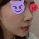 小鼻縮小（切開） / スレッドノーズ / 鼻尖縮小 / ヒアルロン酸注入（鼻） キップン整形外科 DAY 7 サムネイル用