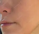 ヒアルロン酸注入（頬） 目白ホワイトクリニック DAY 26 サムネイル用
