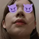 小鼻縮小（切開） / スレッドノーズ / 鼻尖縮小 / ヒアルロン酸注入（鼻） キップン整形外科 DAY 7 サムネイル用