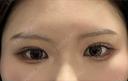 二重埋没 / 糸リフト 銀座みゆき通り美容外科 大阪梅田院 DAY 15 サムネイル用