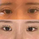 二重埋没 / 脂肪吸引（顔） ルラ美容クリニック 名古屋本院 DAY 6 サムネイル用