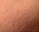 ピーリング（ハリ・ツヤ） / ルメッカ 小倉美容外科/美容皮膚科 ビラビューティークリニック DAY 13 サムネイル用