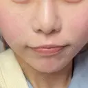 糸リフト / クマ治療 / 脂肪吸引（顔） / 下まぶたたるみ取り / 下まぶたの脂肪取り / ジョールファット除去 / 脂肪注入（目の下） / 脂肪吸引注射（顔） / ヒアルロン酸注入（あご） / ボトックス（エラ・小顔） SEA CLINIC（シークリニック） DAY 30 サムネイル用