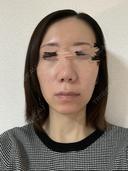その他（鼻） / 軟骨移植 / ワシ鼻修正・ハンプ切除 / 真皮移植 LUHO（ルホ）美容外科 AFTER サムネイル用
