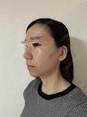 その他（鼻） / 軟骨移植 / ワシ鼻修正・ハンプ切除 / 真皮移植 LUHO（ルホ）美容外科 DAY 182 サムネイル用