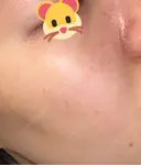 ピコスポット APスキンクリニック銀座 DAY 16 サムネイル用