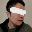 脂肪溶解注射（顔） 上野注入クリニック DAY 13 サムネイル用