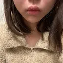 ボトックス（エラ・小顔） / ボトックス（口角） / インモード ルラ美容クリニック 京都院 AFTER サムネイル用
