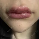 ヒアルロン酸注入（あご） / ヒアルロン酸注入（唇） 麻布十番クレールデンタルクリニック AFTER サムネイル用