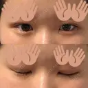 二重埋没 ルラ美容クリニック 渋谷本院 DAY 3 サムネイル用
