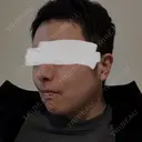 脂肪溶解注射（顔） 上野注入クリニック AFTER サムネイル用