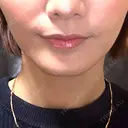 ボトックス（エラ・小顔） / ピアス穴あけ ルラ美容クリニック 横浜院 AFTER サムネイル用