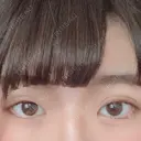 二重切開 / 眼瞼下垂（切開） 広島プルミエクリニック AFTER サムネイル用