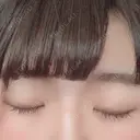 二重切開 / 眼瞼下垂（切開） 広島プルミエクリニック DAY 94 サムネイル用