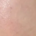 イオン導入 Kinshicho Beauty Clinic （錦糸町ビューティークリニック） AFTER サムネイル用