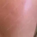 イオン導入 Kinshicho Beauty Clinic （錦糸町ビューティークリニック） DAY 0 サムネイル用