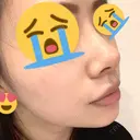 小鼻縮小（切開） / スレッドノーズ / 鼻尖縮小 / ヒアルロン酸注入（鼻） キップン整形外科 DAY 10 サムネイル用