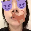 小鼻縮小（切開） / スレッドノーズ / 鼻尖縮小 / ヒアルロン酸注入（鼻） キップン整形外科 DAY 10 サムネイル用