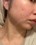 ほくろ・いぼ除去レーザー（肌） / ピコスポット Fellez Clinic【フェルズクリニック】 DAY 10 サムネイル用