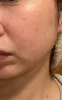 ほくろ・いぼ除去レーザー（肌） / ピコスポット Fellez Clinic【フェルズクリニック】 DAY 10 サムネイル用