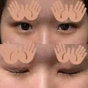 二重埋没 ルラ美容クリニック 渋谷本院 DAY 4 サムネイル用