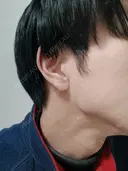 ボトックス（エラ・小顔） 白金ビークリニック 本院 AFTER サムネイル用