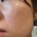ルメッカ やさしい美容皮膚科・皮フ科　秋葉原院 AFTER サムネイル用
