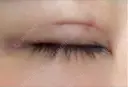 二重埋没 MEMOTO CLINIC 名古屋 DAY 4 サムネイル用