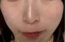 ピコスポット G MEDICAL ART クリニック 新宿院 AFTER サムネイル用