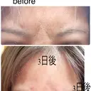 小鼻縮小（非切開） / ボトックス（眉間） / ボトックス（目尻） / ボトックス（額） / ボトックス（ガミースマイル） TCB東京中央美容外科 札幌大通院 AFTER サムネイル用