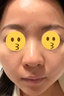 ニードルRF（ポテンツァなど） エトワールレジーナクリニック新宿院 DAY 3 サムネイル用