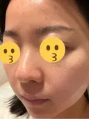 ニードルRF（ポテンツァなど） エトワールレジーナクリニック新宿院 DAY 3 サムネイル用