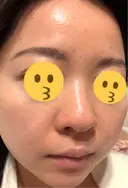 ニードルRF（ポテンツァなど） エトワールレジーナクリニック新宿院 DAY 3 サムネイル用