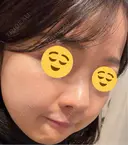 ニードルRF（ポテンツァなど） エトワールレジーナクリニック新宿院 DAY 5 サムネイル用