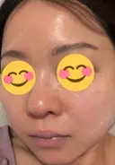 ニードルRF（ポテンツァなど） エトワールレジーナクリニック新宿院 AFTER サムネイル用