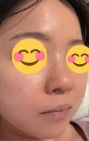 ニードルRF（ポテンツァなど） エトワールレジーナクリニック新宿院 DAY 6 サムネイル用